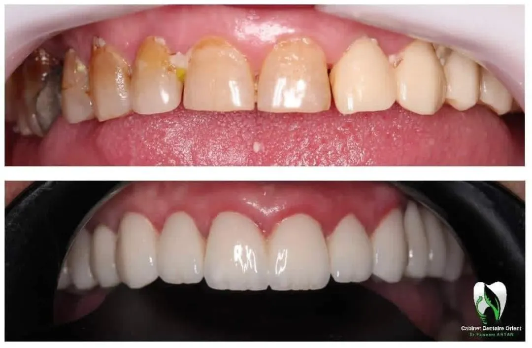 تجميل ابتسامة بعدسات الفينير